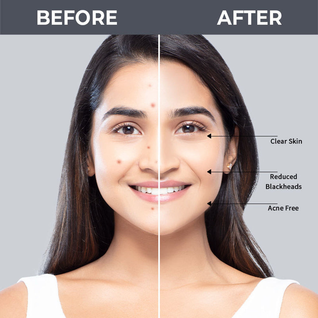Nykaa SKINRX 2% Salicylic Acid Face Serum | Grocsy