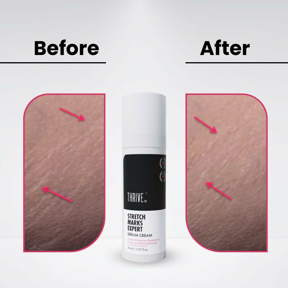 ThriveCo Stretch Marks Expert Serum Cream | Grocsy