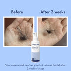 WishCare Hair Growth Serum Concentrate with Redensyl & Rosemary-In-Vivo Tested-Controls Hairfall | Grocsy