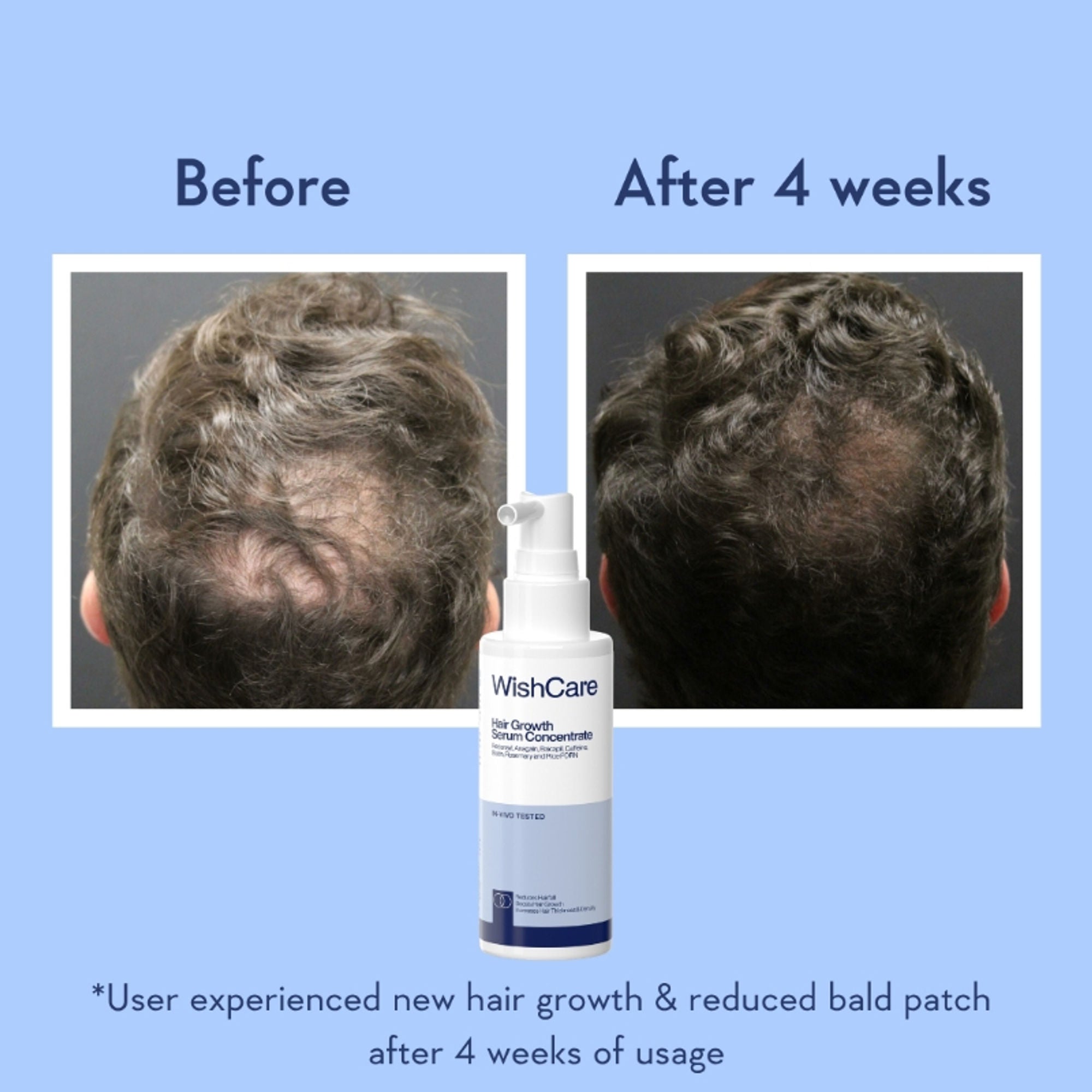 WishCare Hair Growth Serum Concentrate with Redensyl & Rosemary-In-Vivo Tested-Controls Hairfall | Grocsy
