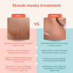 Skinvest Bomb bum cream for Stretch Marks + Cellulite | Grocsy