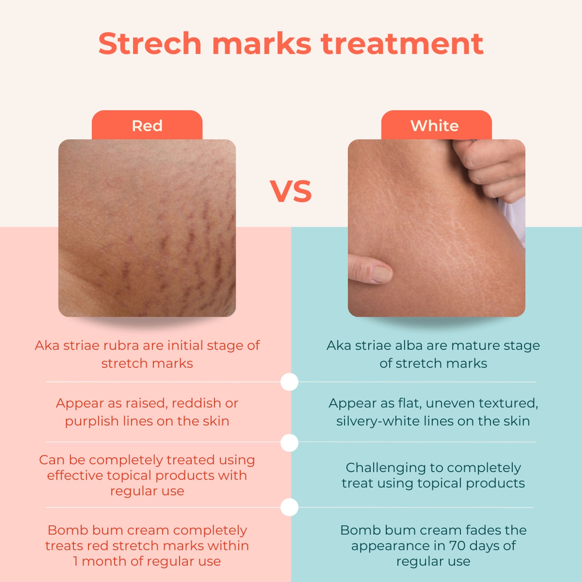 Skinvest Bomb bum cream for Stretch Marks + Cellulite | Grocsy
