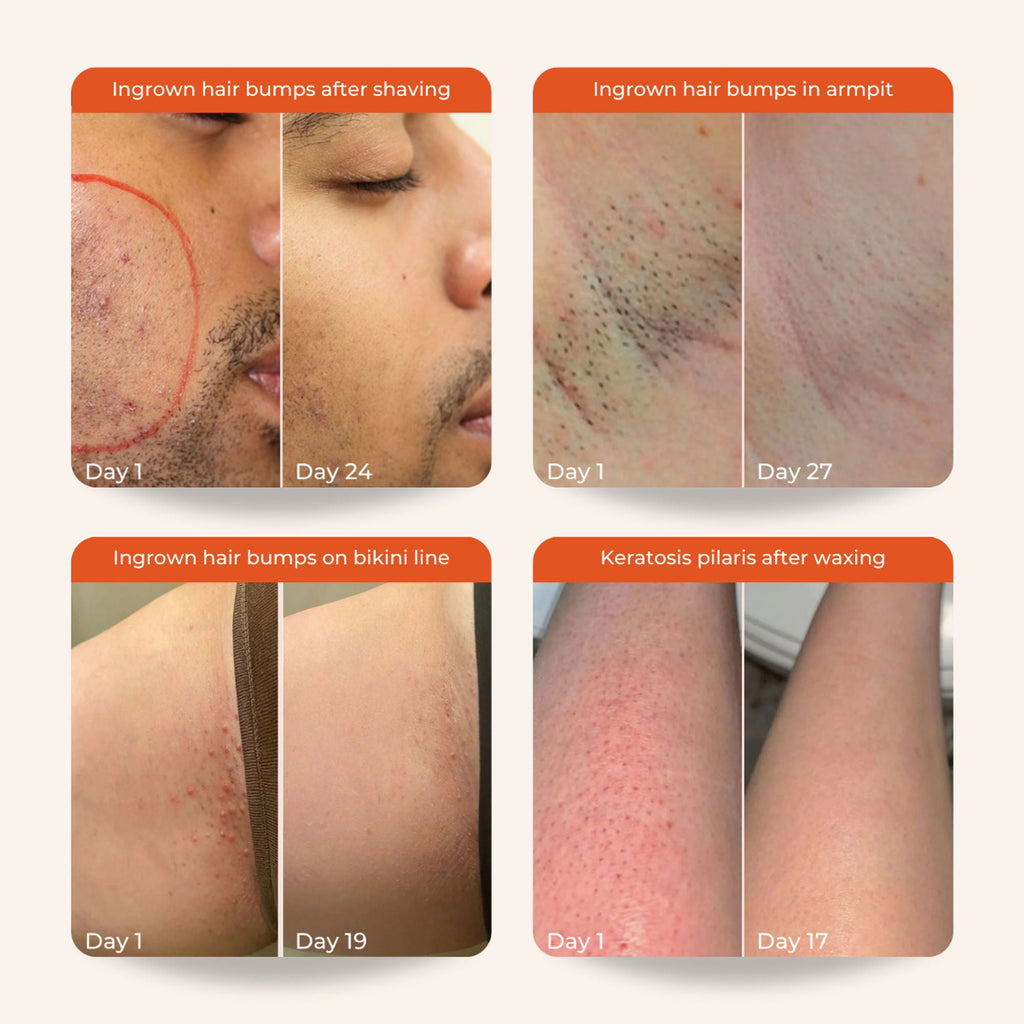 Skinvest Bye Bye Bumps - Exfoliating Body Mist | Grocsy