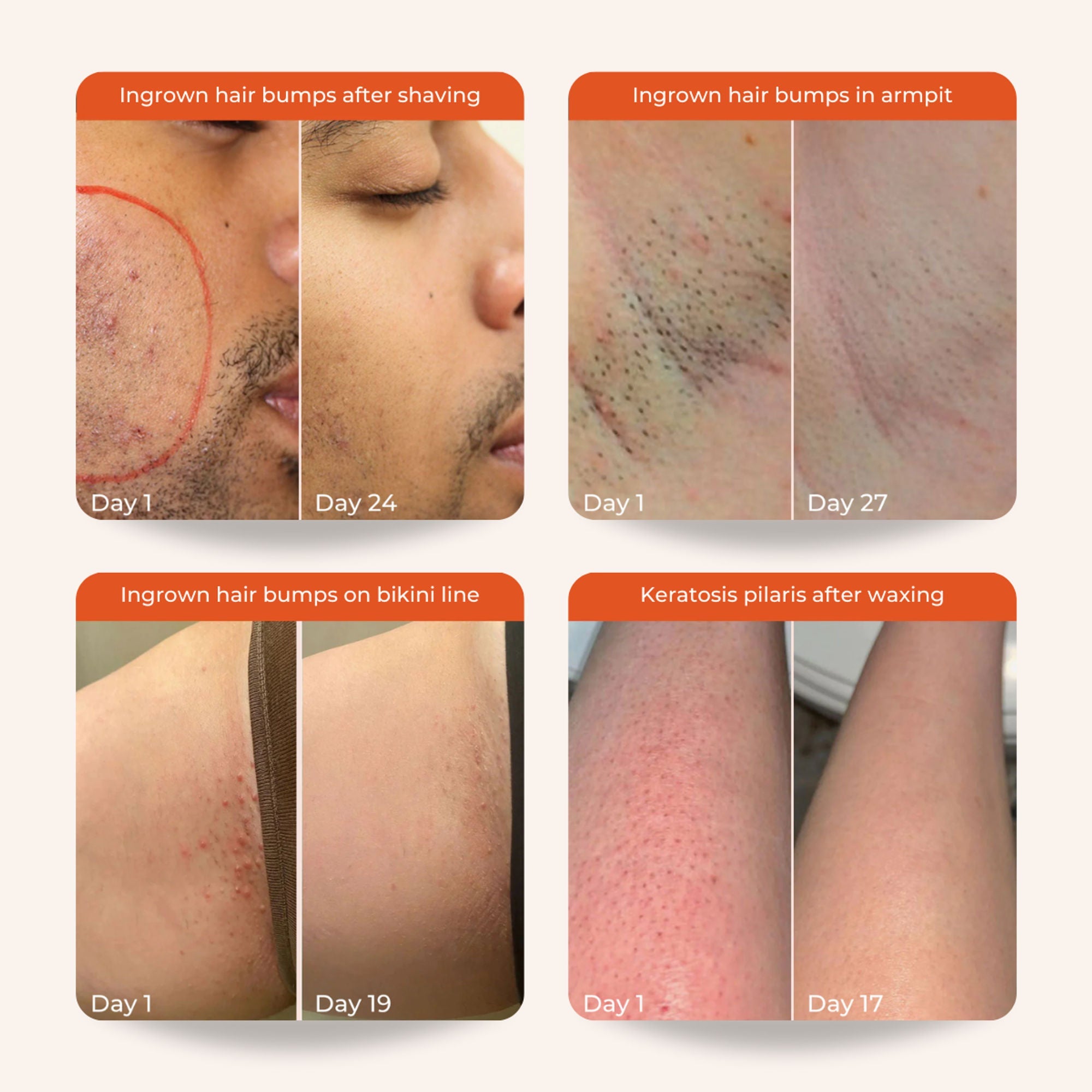 Skinvest Bye Bye Bumps - Exfoliating Body Mist | Grocsy