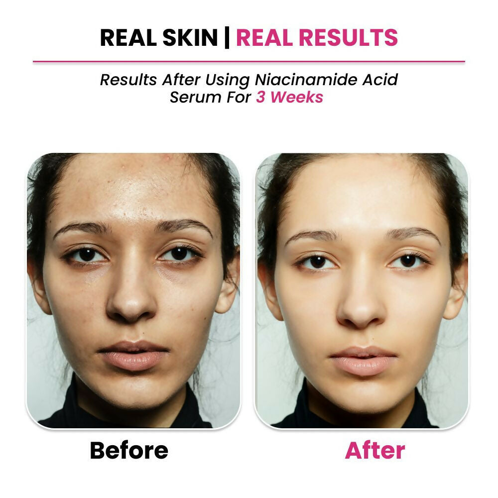 Thriveco 10% Niacinamide + 1% Zinc Pca Serum | Grocsy