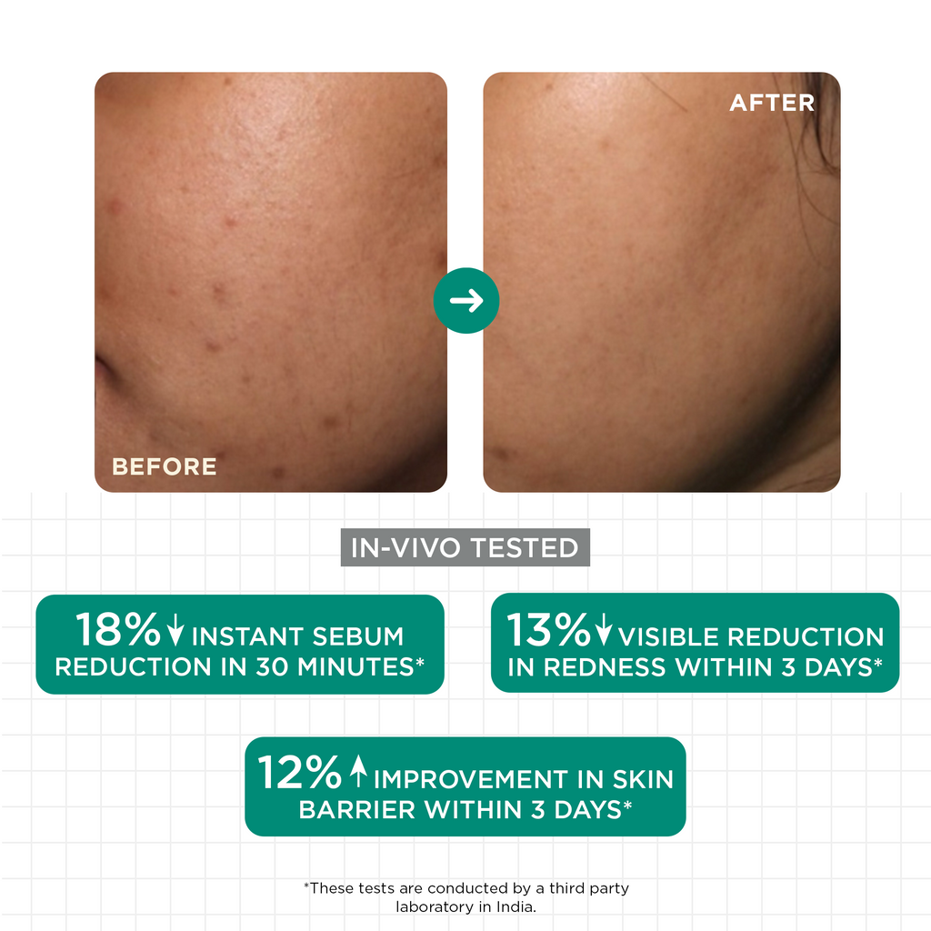 SkinQ Acne & Oil Control Serum | Grocsy