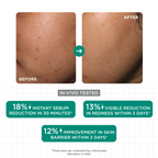 SkinQ Acne & Oil Control Serum | Grocsy