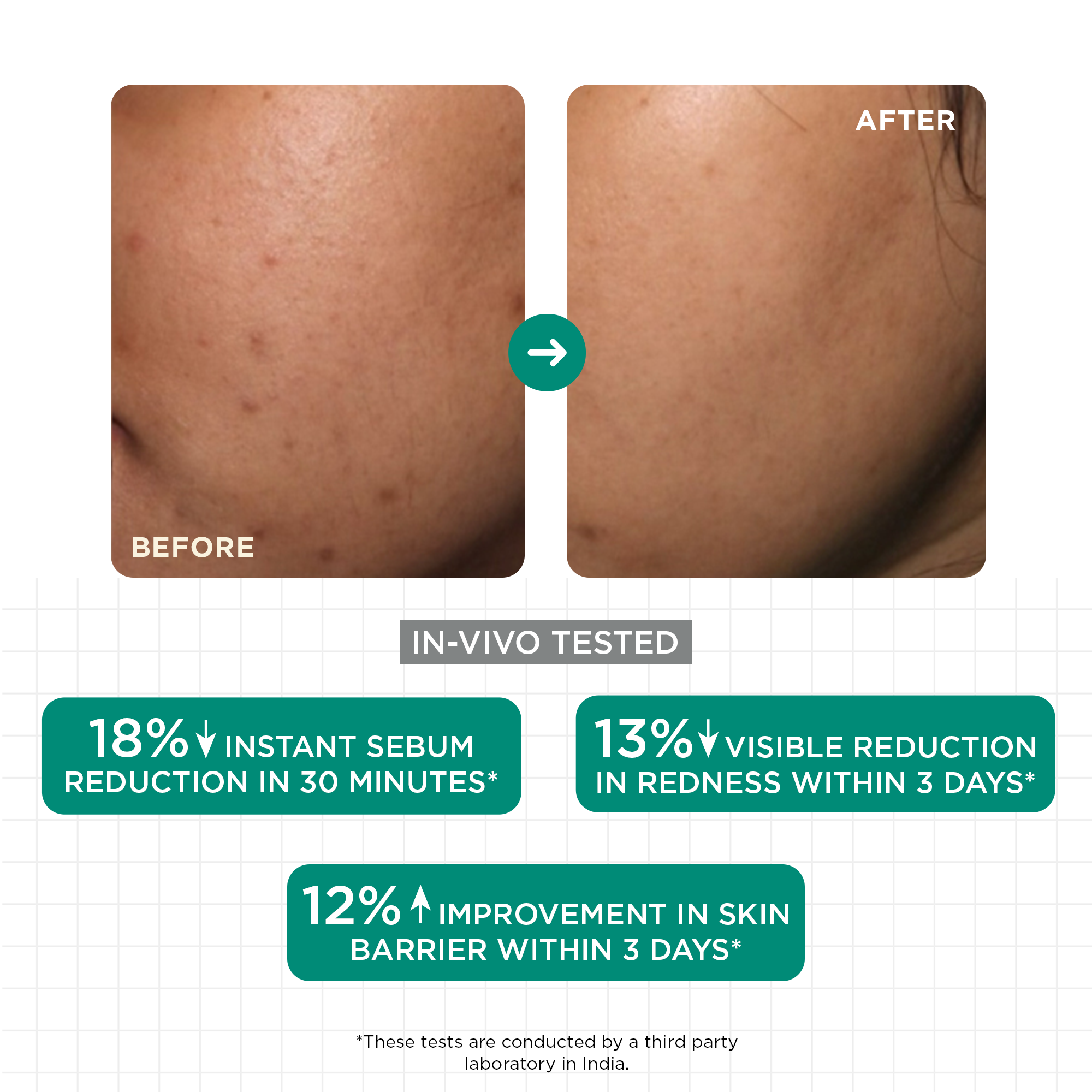 SkinQ Acne & Oil Control Serum | Grocsy