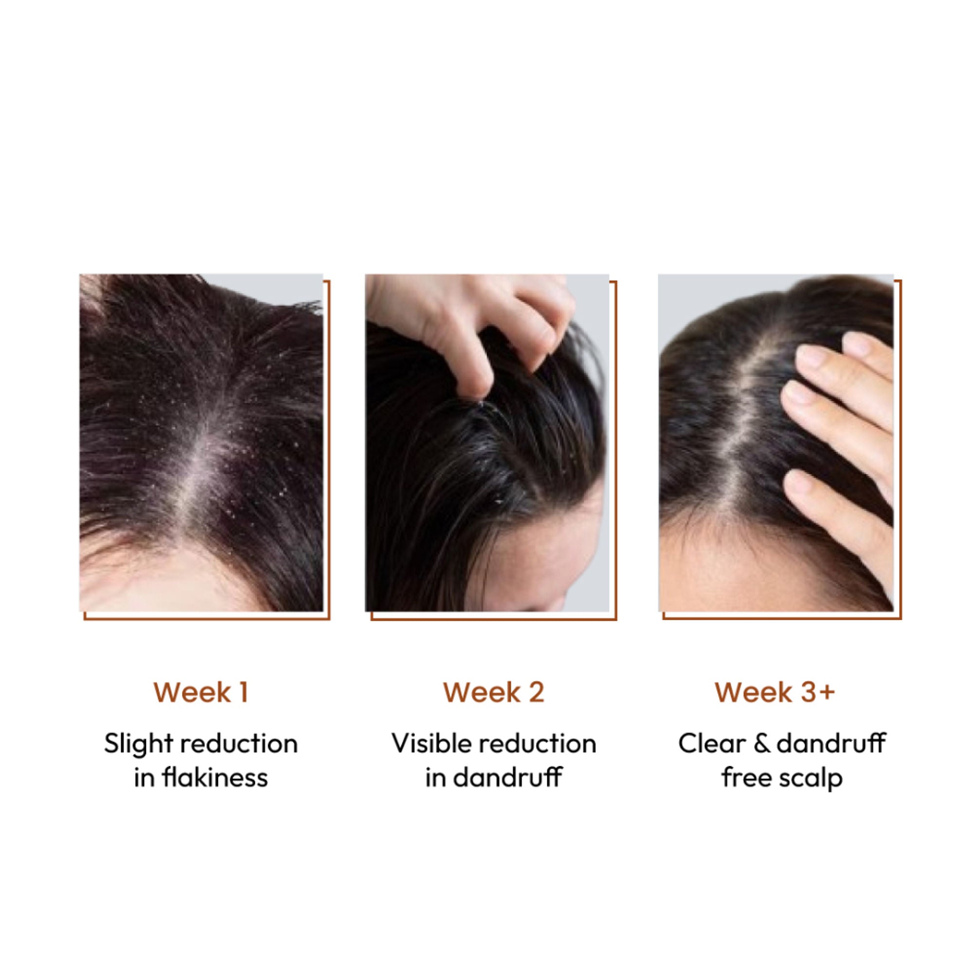 SANCTUS 4% Dandelix Pro Anti-Dandruff Hair Serum For Scalp | Grocsy