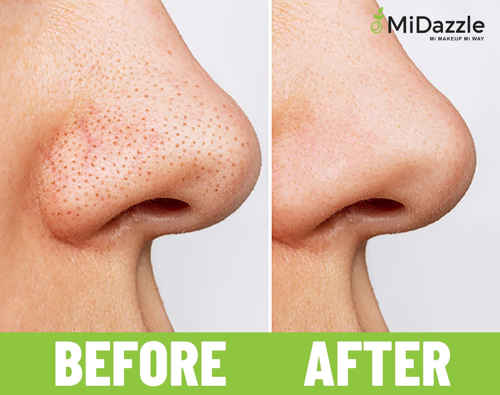 MiDazzle Black Head Remover MIBR3301 | Grocsy