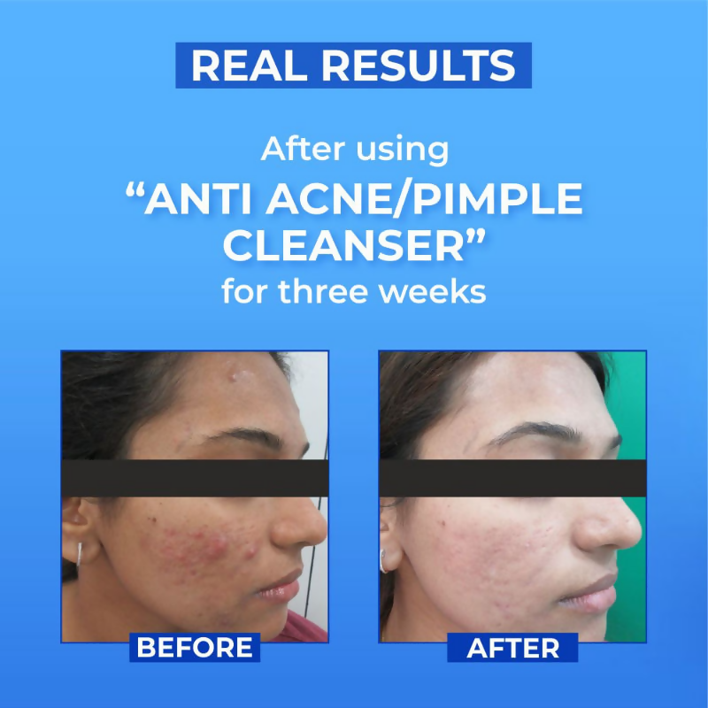 Dr.Sakhiya Anti Acne/Pimple Face Cleanser | Grocsy