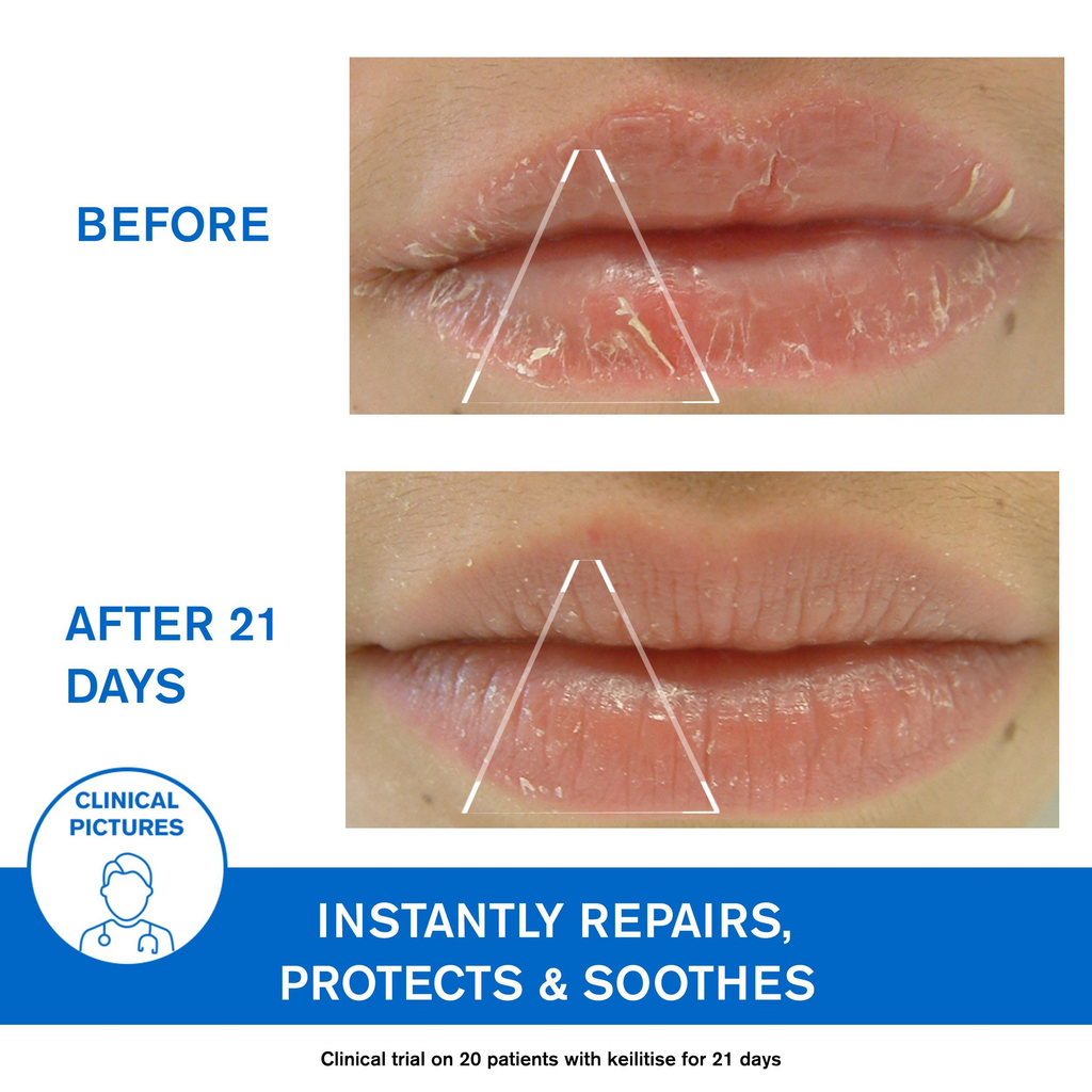 Uriage Bariederm-Cica Protecting Lip Balm For Dry,Cracked & Chapped Lips With Squalane & PHytosterol | Grocsy