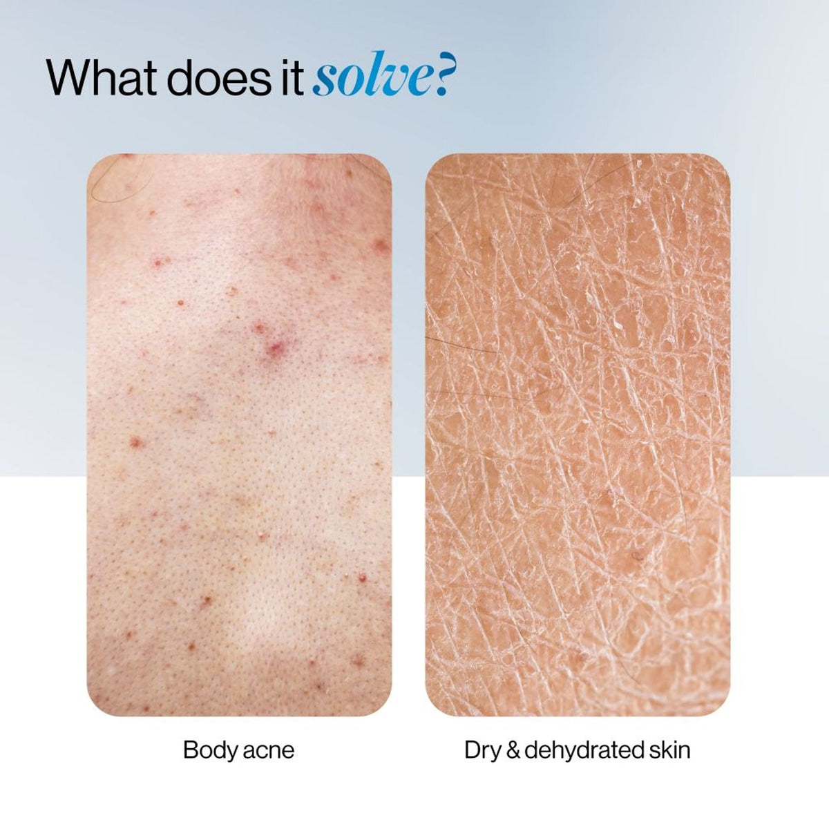 BeBodywise 1% Salicylic Ceramide Body Wash - Dual Pump 2in1 Body Wash - For Body Acne and Dry Skin | Grocsy