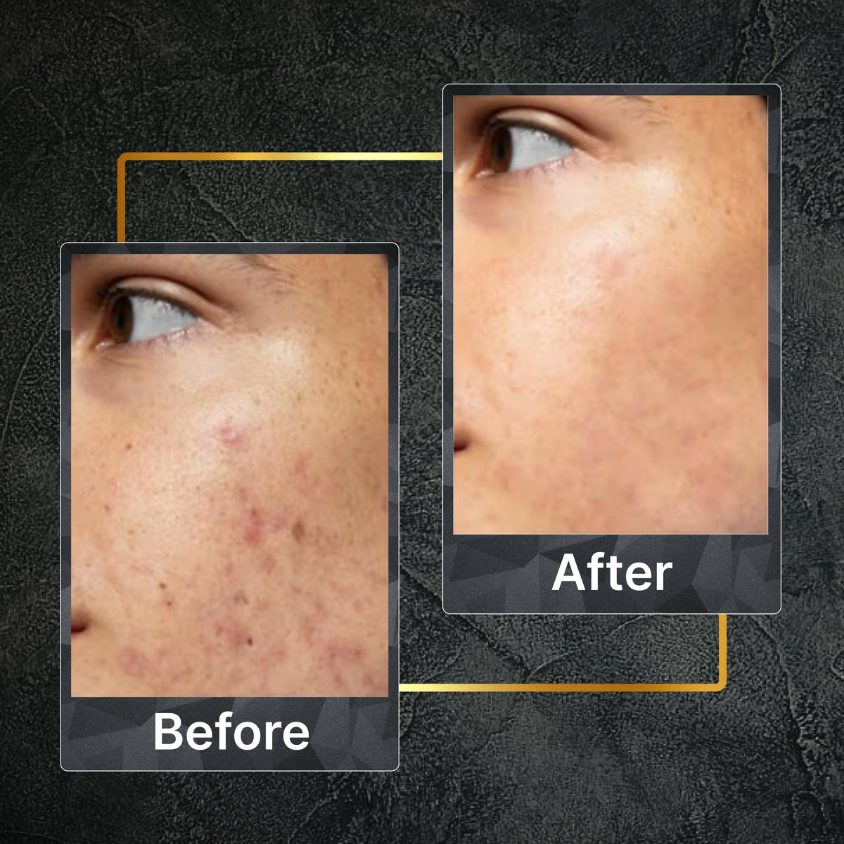 Tru Hair & Skin Nanotechnology Facewash For Sensitive-Acne Prone Skin | Grocsy