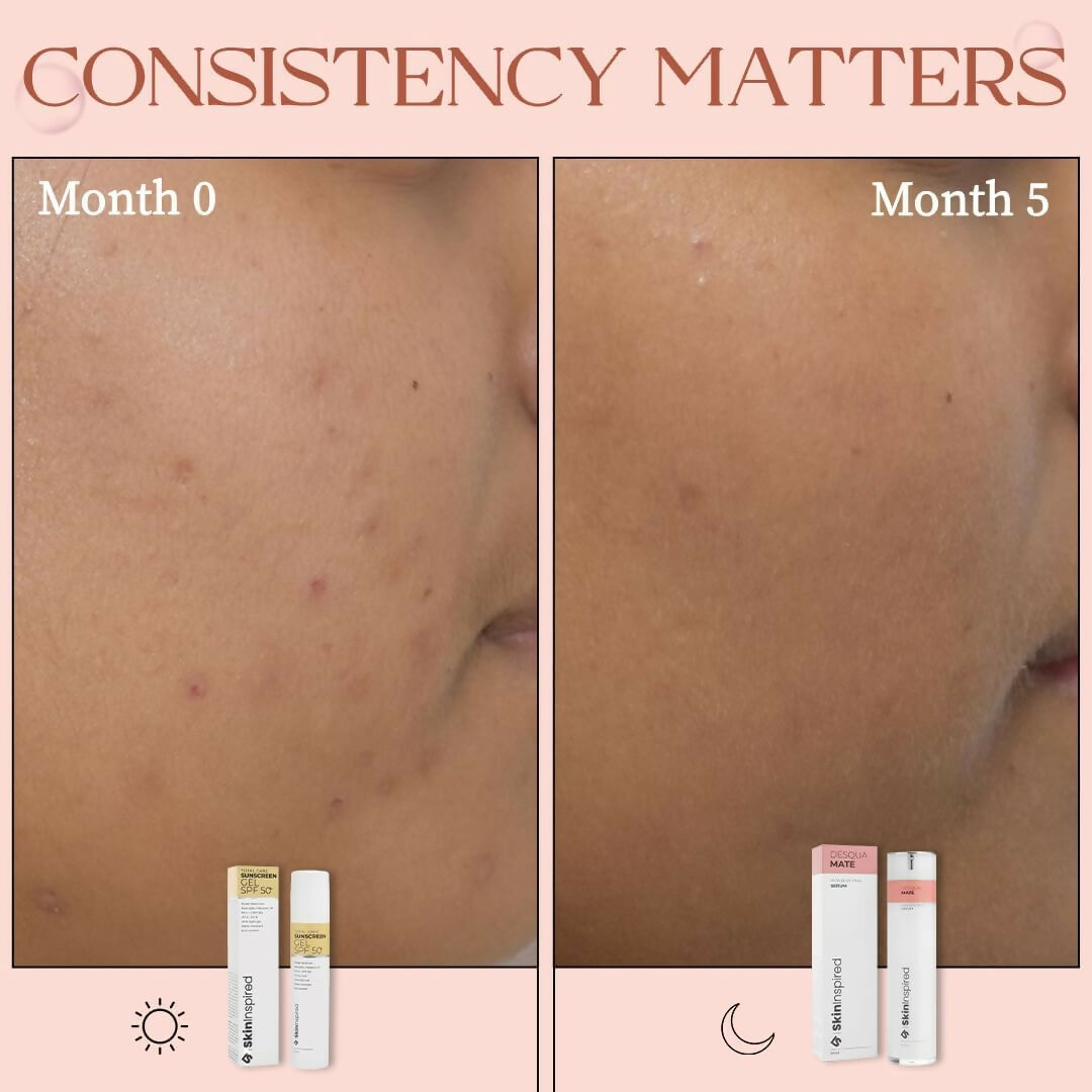 SkinInspired AHA+BHA+PHA Lactic Acid + 2% Salicylic Acid Face Serum | Grocsy