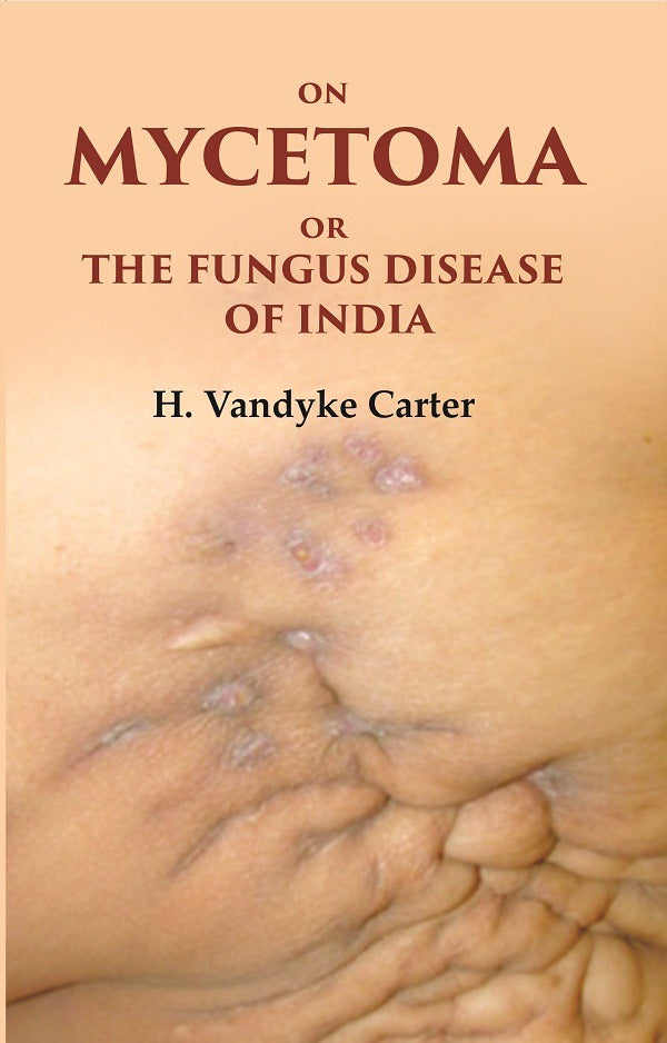 On Mycetoma or the Fungus Disease of India - Gyan Books | Grocsy