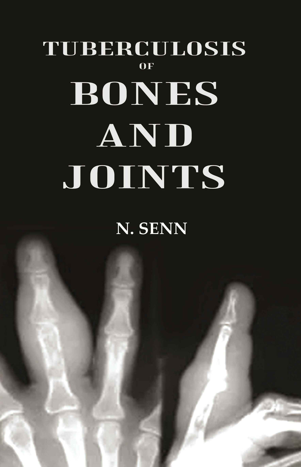 Tuberculosis of Bones and Joints - Gyan Books | Grocsy