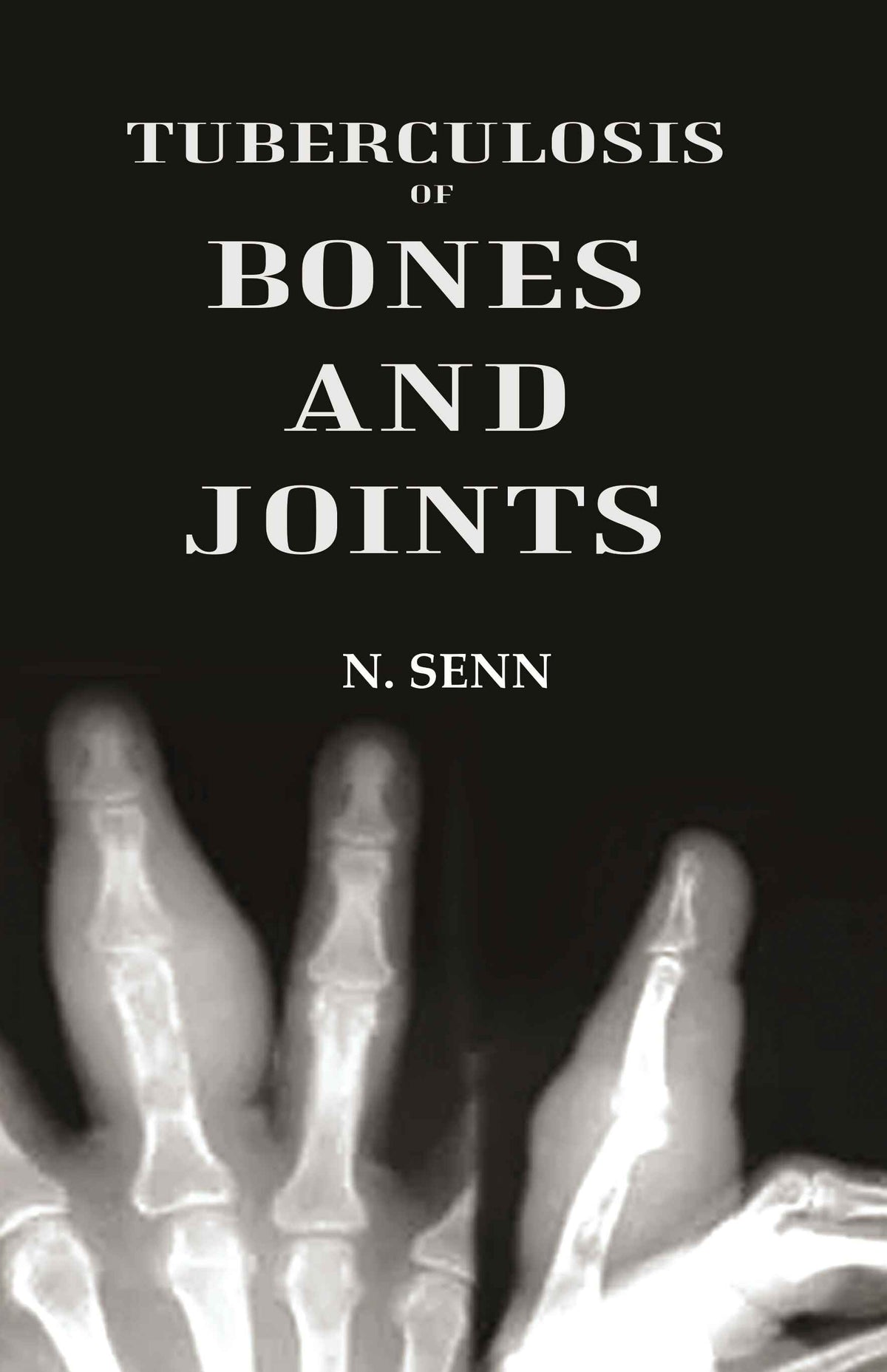 Tuberculosis of Bones and Joints - Gyan Books | Grocsy