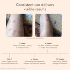 VedicDerm Oleander's Oil for Psoriasis, Eczema, and Atopic Dermatitis | Grocsy
