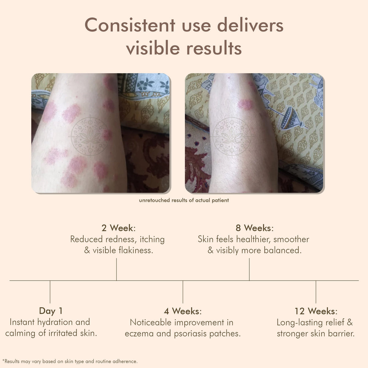 VedicDerm Oleander's Oil for Psoriasis, Eczema, and Atopic Dermatitis | Grocsy