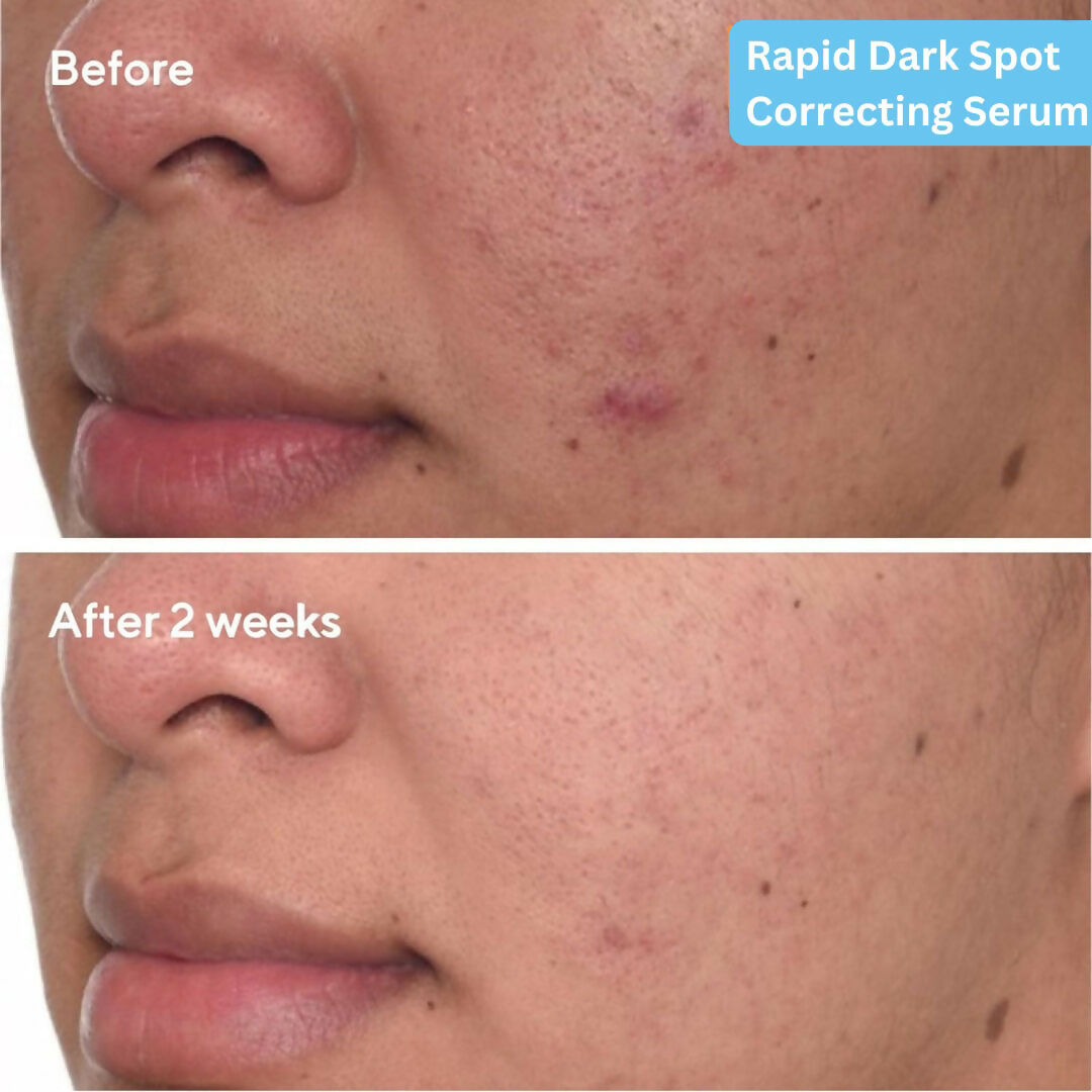SkinLuv Dark Spot Correcting Serum | Grocsy