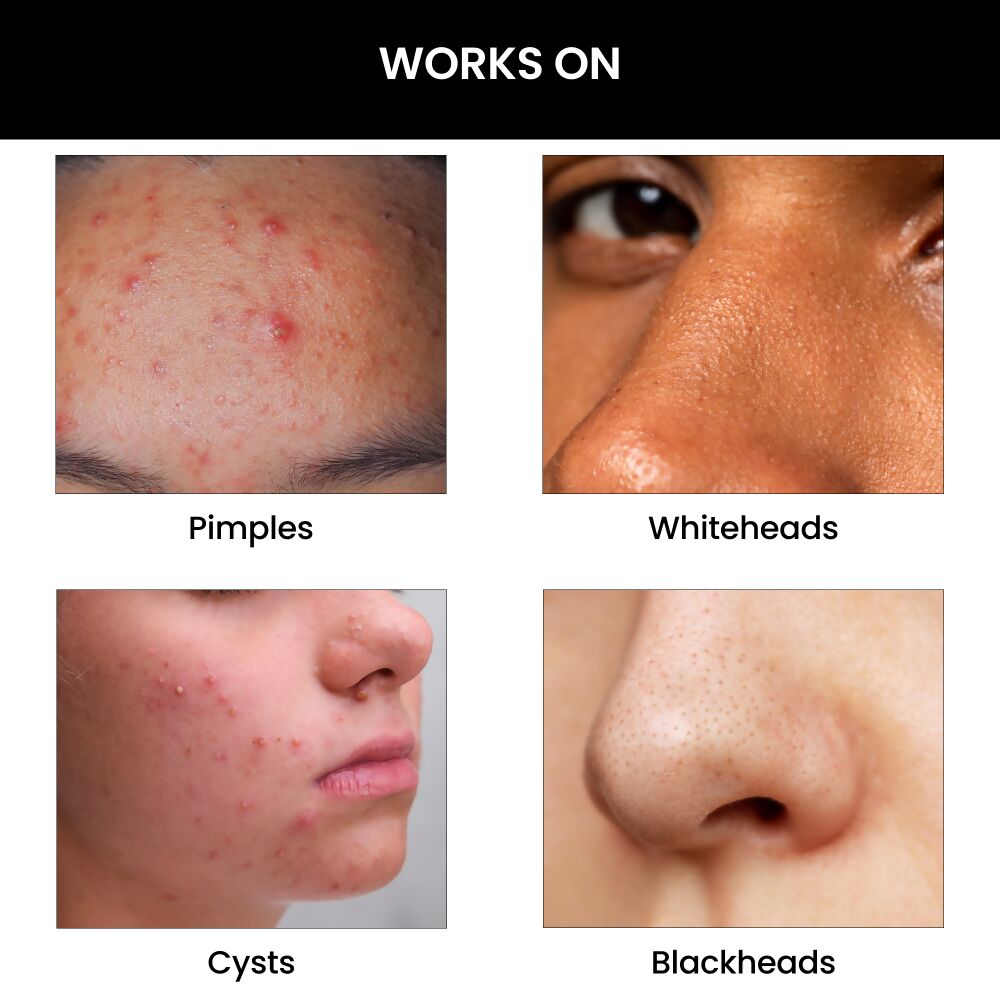 ThriveCo Goodbye Acne Cleanser | Grocsy