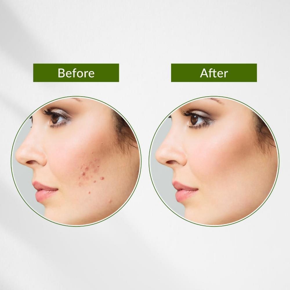 Lotus Botanicals Neem, Tulsi & Salicylic Acid Anti-Acne Purifying Face Gel | Grocsy