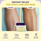 Sanfe Eczema Relief Cream For Very Very Dry Skin | Grocsy
