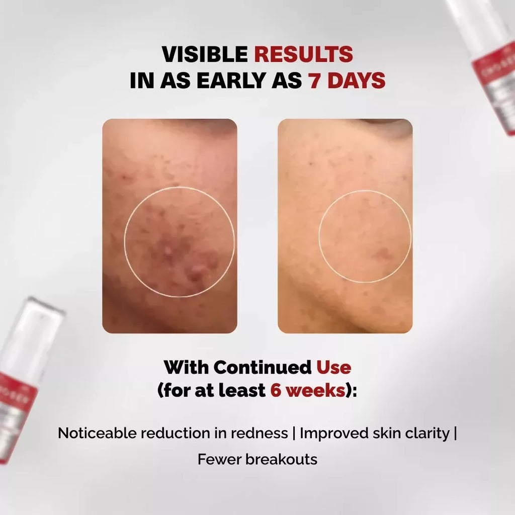Chosen Re(D)Covery Serum Best Brightening Tranexamic Acid Serum | Grocsy