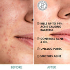 mCaffeine 2% Salicylic Acid Serum Clear Skin Acne Pads - Acne & Oil Control with Matcha Tea | Grocsy