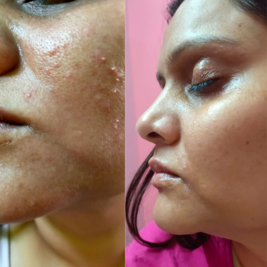 House of Beauty Acne Drying Serum | Grocsy