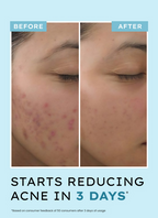 Hyphen By Kriti Sanon Acne Defence Daily Serum With 2% Salicylic Acid Treats Active Acne Prevents Breakouts | Grocsy