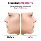 ThriveCo 2% Salicylic acid Serum | Grocsy