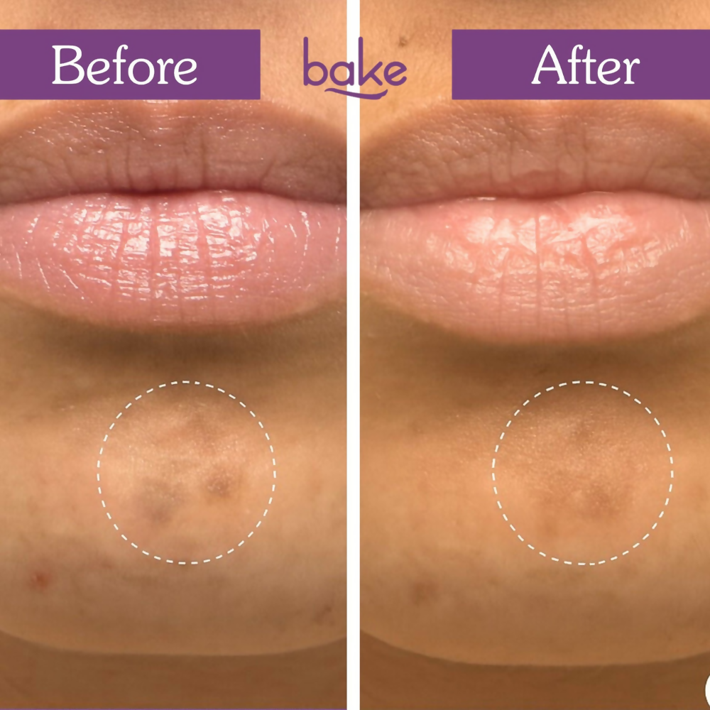 Bake Spot Erase Micropoint Hydrocolloid Patches for Dark Spots | Grocsy