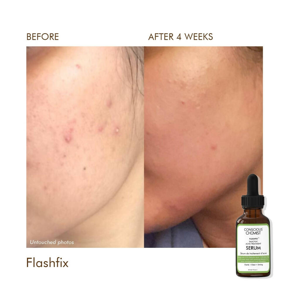 Conscious Chemist Flashfix Salicylic Acne Serum | Grocsy
