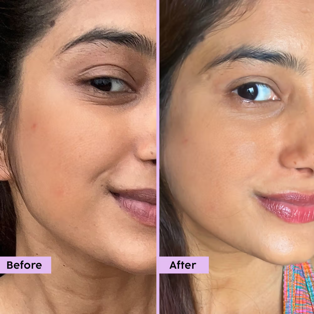 PLIX The Plant Fix - Jamun Active Acne Regime With Cleanser & Toner To Unclog Pores & Reduce Acne | Grocsy