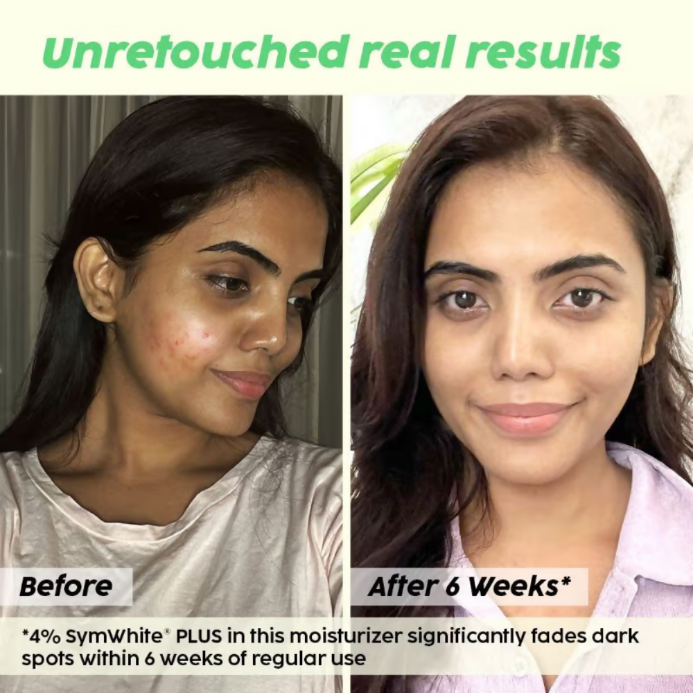 PLIX The Plant Fix 2% Alpha Arbutin Pineapple Moisturizer With SymWhite PLUS For Hyperpigmentation & Dark Spots | Grocsy