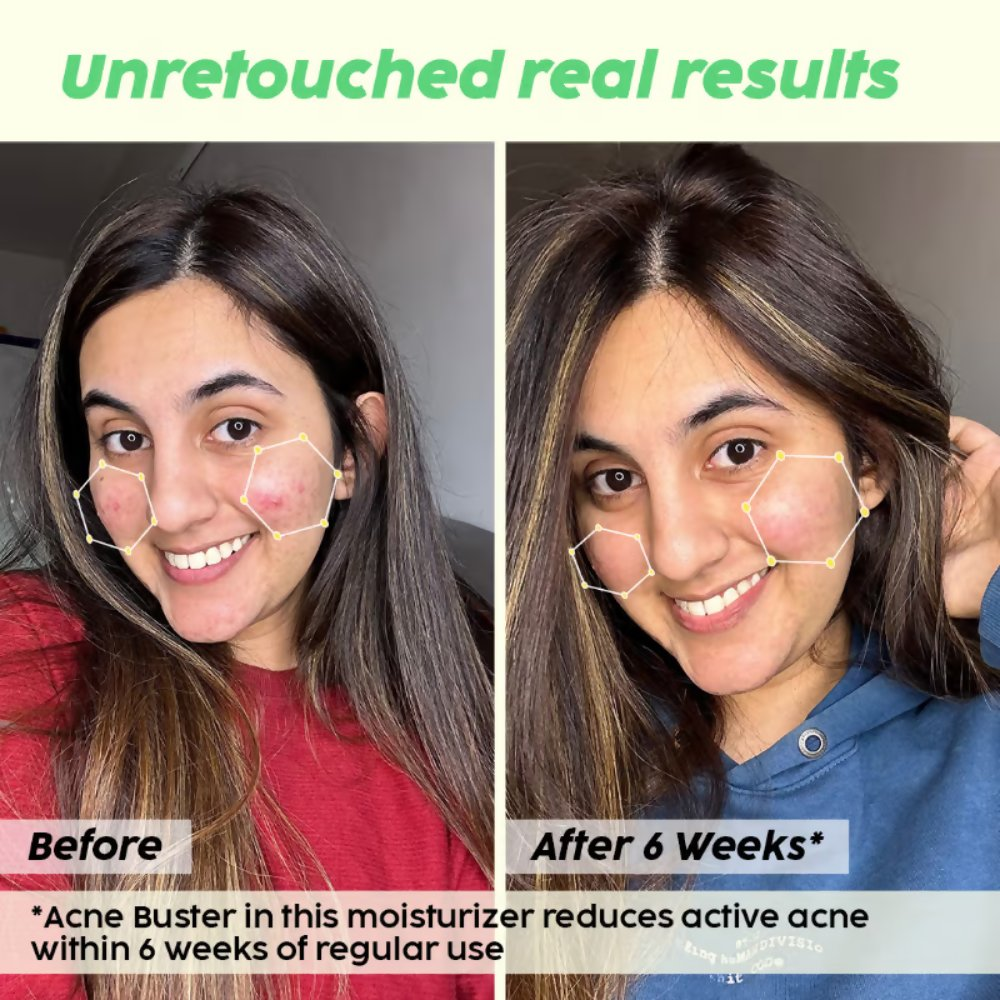 PLIX The Plant Fix 2% Salicylic Acid Active Acne Control Serum & Acne Buster Moisturizer Combo | Grocsy