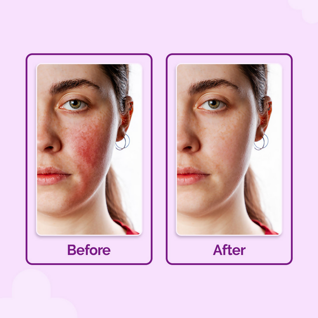 The Derma Co Hypochlorous Anti-Acne Hydrating Spray | Grocsy