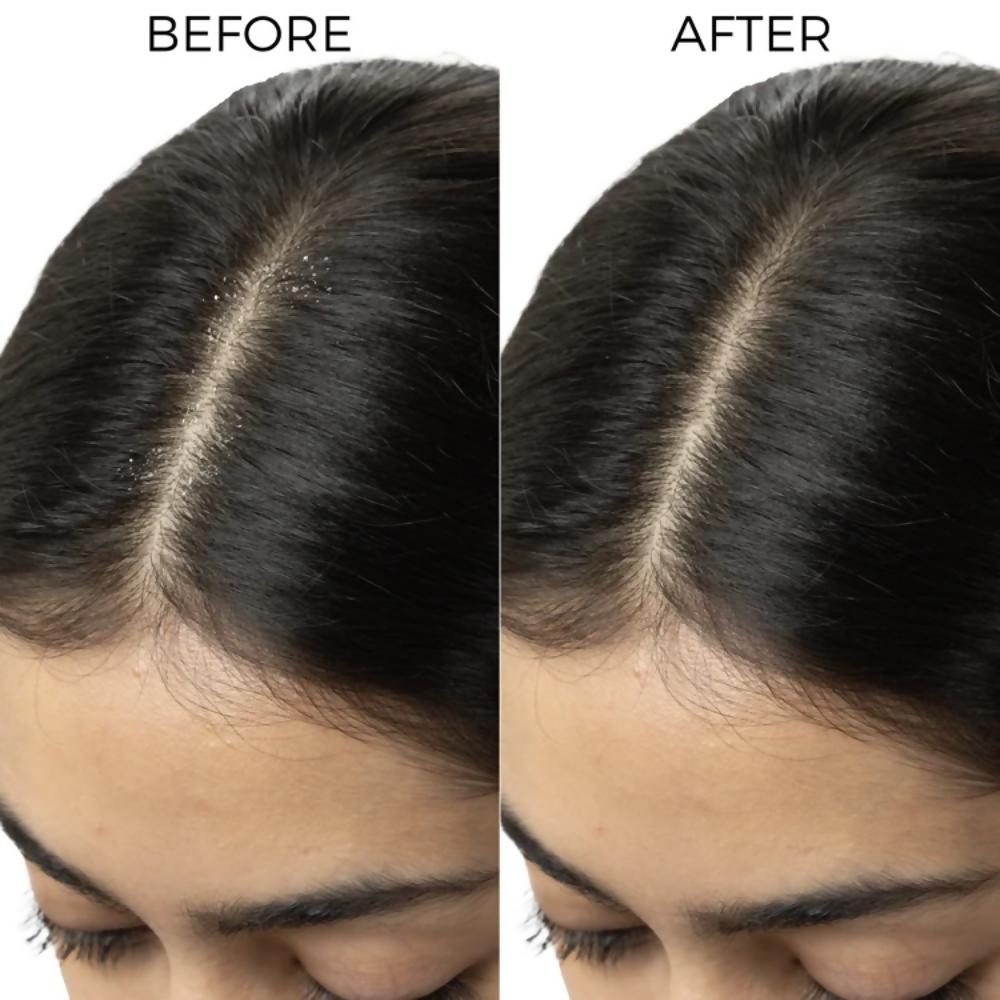Brillare Dandruff Control Kit | Grocsy