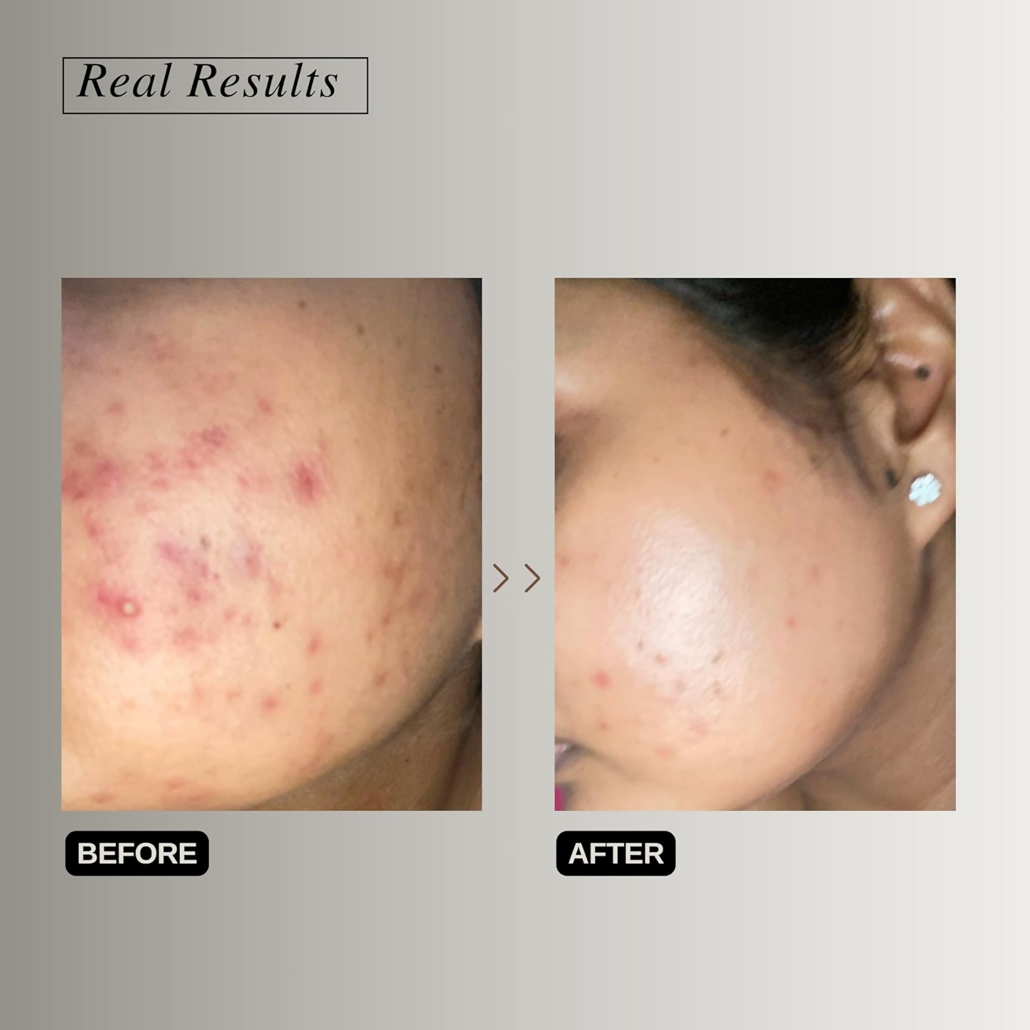 The Formularx Barrier Relief Ceramide Lightweight Moisturizer With Niacinamide & Hyaluronic Acid | Grocsy