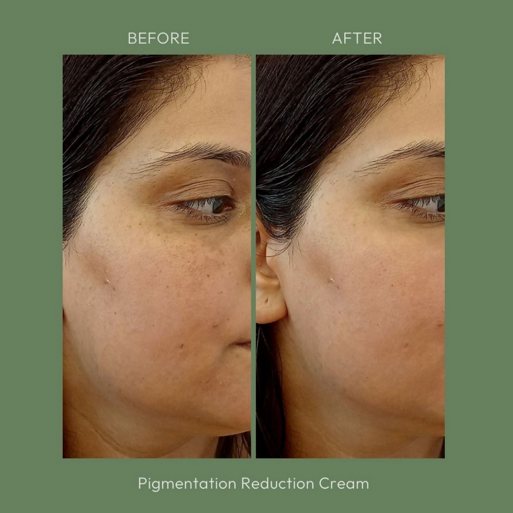 House of Beauty Pigmentation Reduction Cream | Grocsy