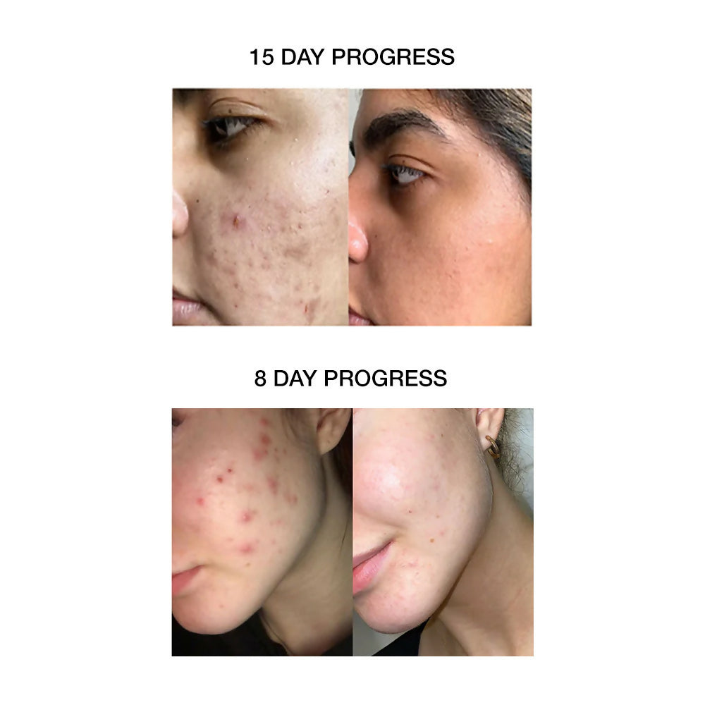 Skog Acne Clarifying Gel | Grocsy