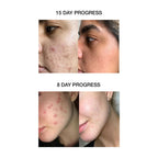 Skog Acne Clarifying Gel | Grocsy
