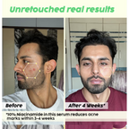 PLIX The Plant Fix 2% Acne Buster Moisturizer & 10% Niacinamide Serum | Grocsy