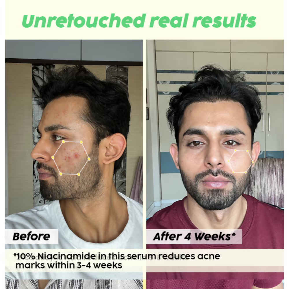 PLIX The Plant Fix 2% Acne Buster Moisturizer & 10% Niacinamide Serum | Grocsy
