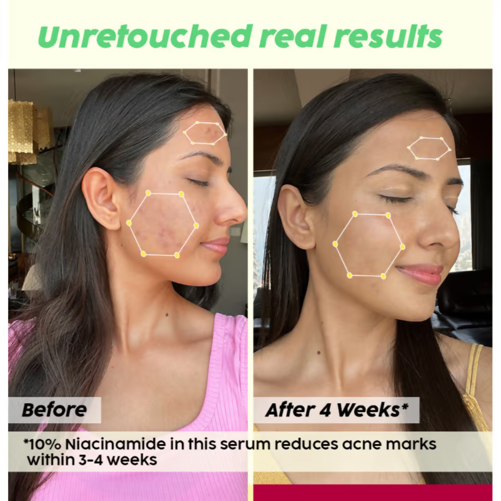 PLIX The Plant Fix 2% Acne Buster Moisturizer & 10% Niacinamide Serum | Grocsy