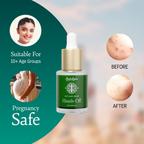 Indulgeo Essentials Heads Off Anti Acne Face Serum | Grocsy