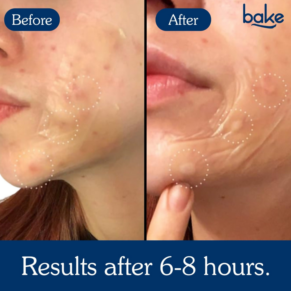 Bake Acne Erase XL Pimple Patches & Nose Patches | Grocsy