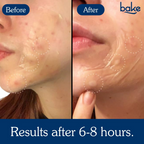 Bake Acne Erase XL Pimple Patches & Nose Patches | Grocsy